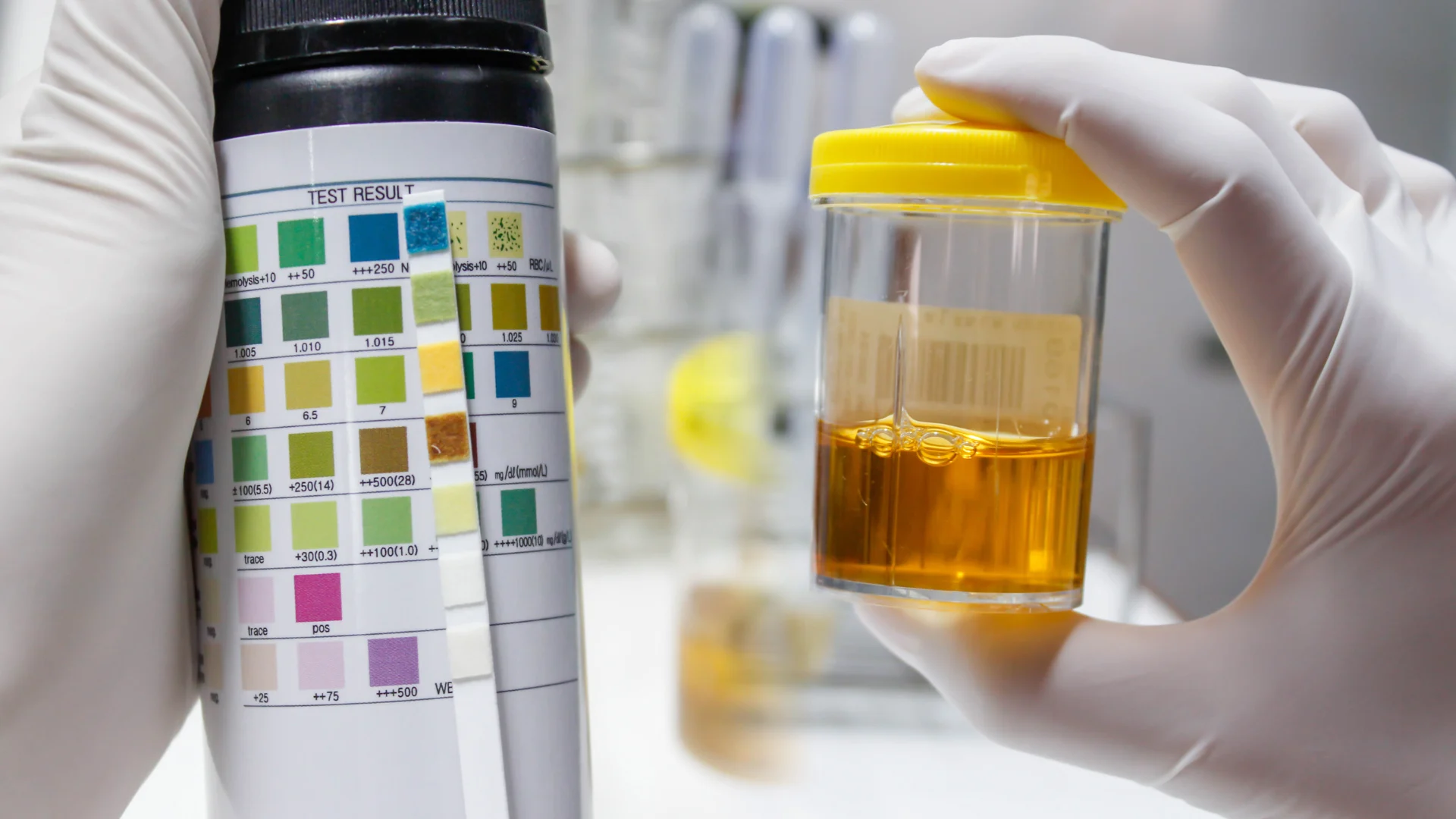 Urine Culture Test